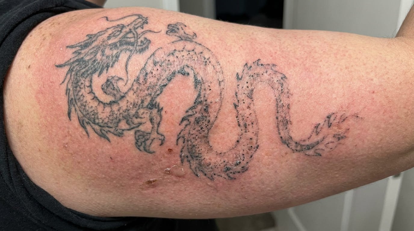 Tatuaje aclarado con láser antes de realizar un cover-up